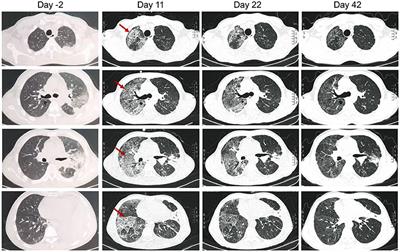 Case Report: Community-Acquired Legionella gormanii Pneumonia in an Immunocompetent Patient Detected by Metagenomic Next-Generation Sequencing